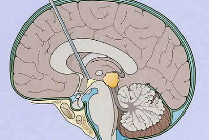 腦導水管堵塞不知怎么辦？可做內鏡探查