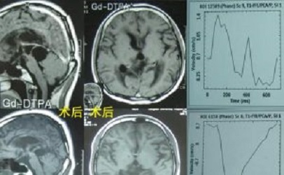 松果體區腫瘤術后腦積水患者zl案例