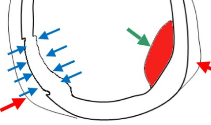 腦出血并發(fā)腦積水多數(shù)因血腫導致