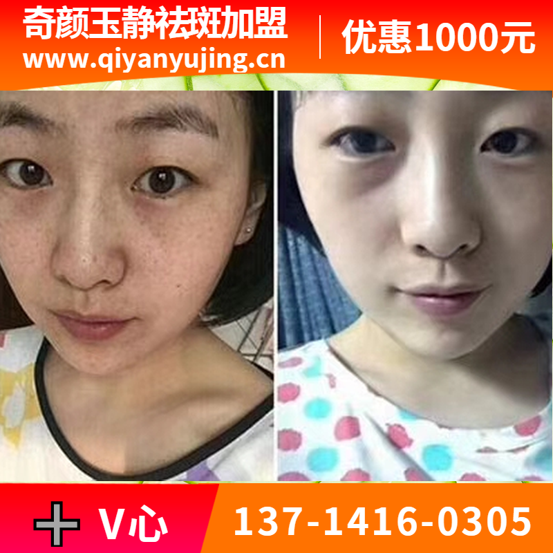 深圳奇颜玉静专业性，通过液氮介质,准确无误到达雀斑基因所在层