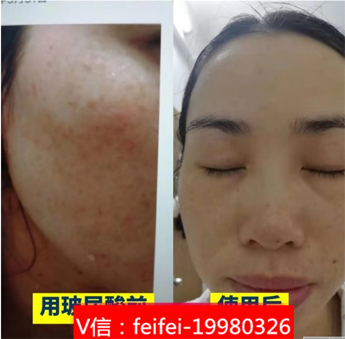 xeq玻尿酸原液精華液用了長(zhǎng)痘【代理如何做】xeq玻尿酸原液精華液深層補(bǔ)水面膜